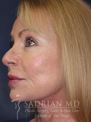 Face & Neck Lift Before & After Image