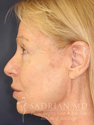 Face & Neck Lift Before & After Image