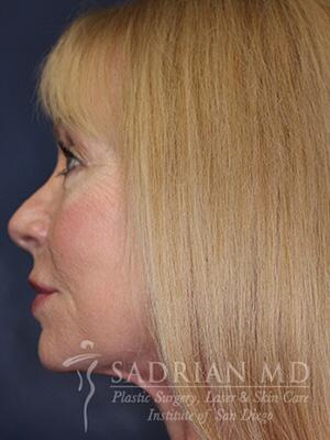 Face & Neck Lift Before & After Image