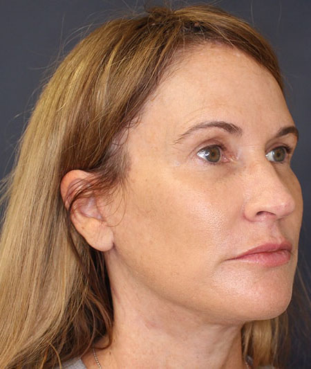 Face & Neck Lift Before & After Image