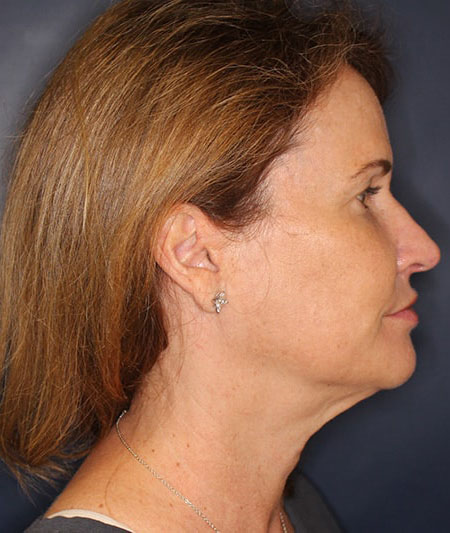 Face & Neck Lift Before & After Image