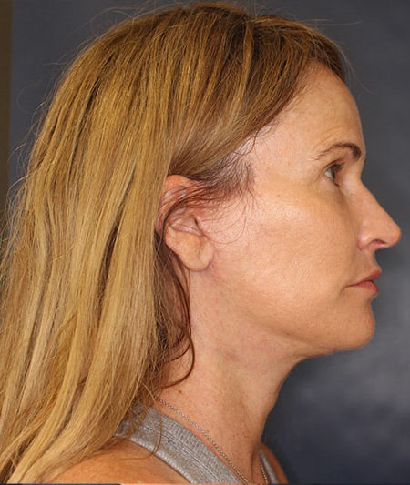 Face & Neck Lift Before & After Image