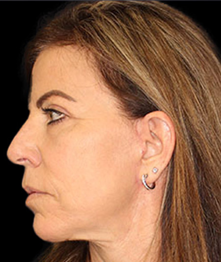 Face & Neck Lift Before & After Image