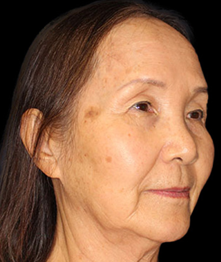 Face & Neck Lift Before & After Image