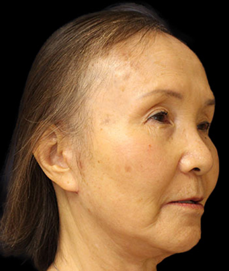 Face & Neck Lift Before & After Image