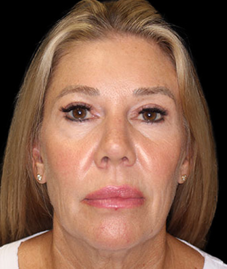 Face & Neck Lift Before & After Image