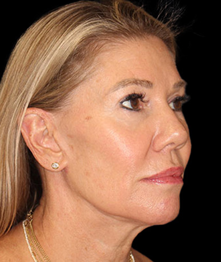 Face & Neck Lift Before & After Image