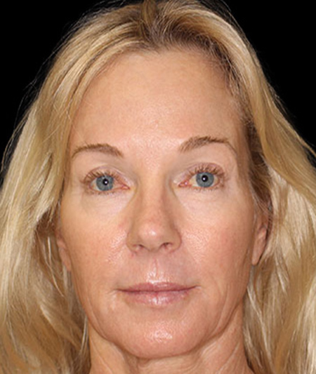 Face & Neck Lift Before & After Image