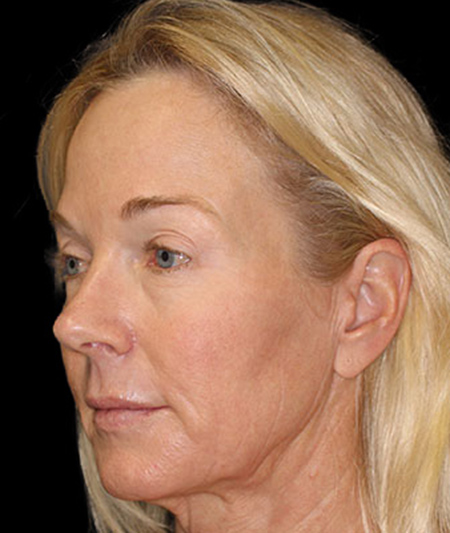 Face & Neck Lift Before & After Image