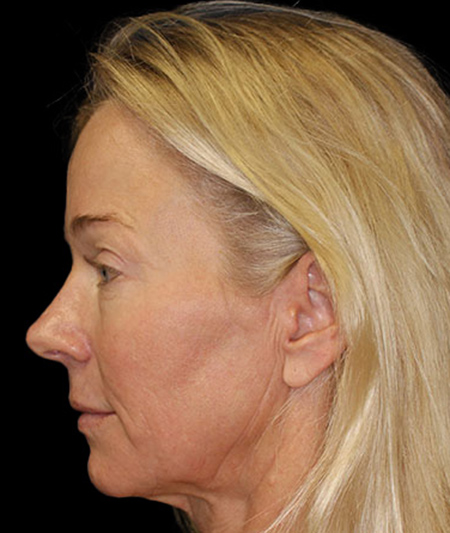 Face & Neck Lift Before & After Image