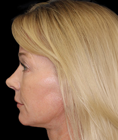 Face & Neck Lift Before & After Image