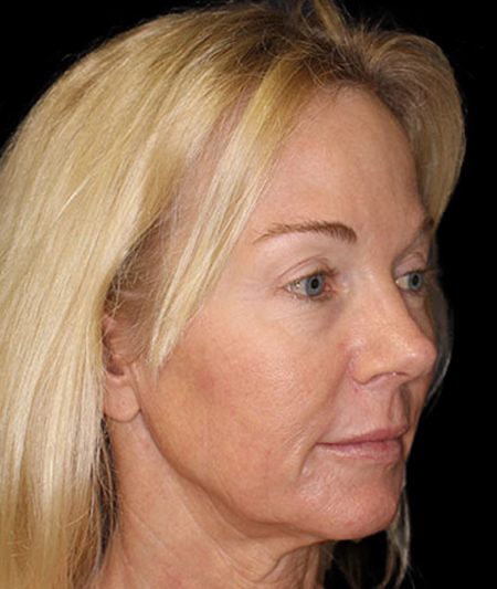 Face & Neck Lift Before & After Image