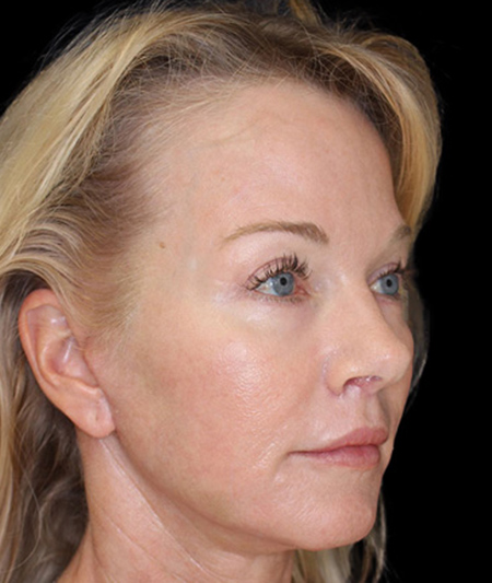 Face & Neck Lift Before & After Image