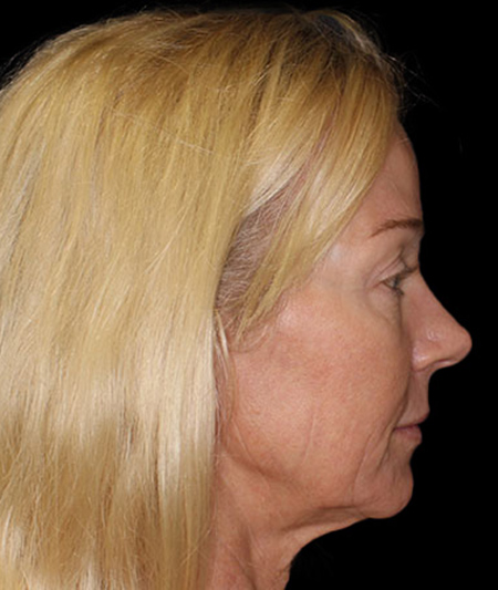 Face & Neck Lift Before & After Image