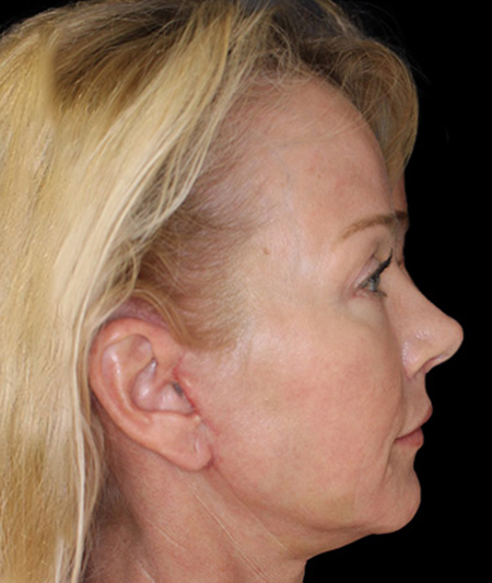 Face & Neck Lift Before & After Image