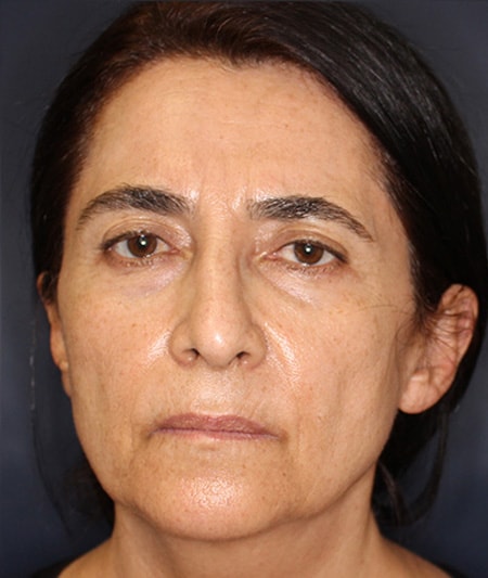 Face & Neck Lift Before & After Image