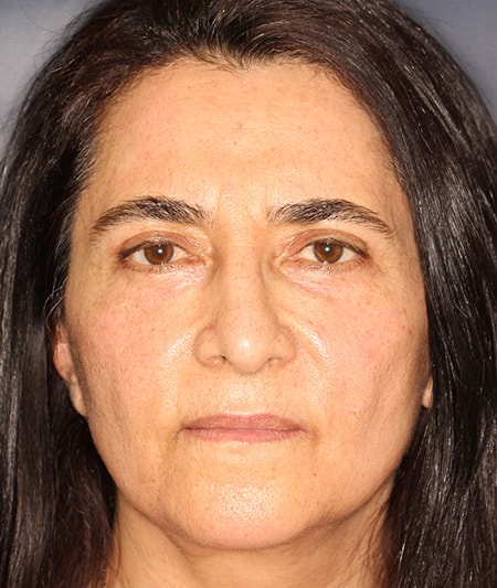 Face & Neck Lift Before & After Image