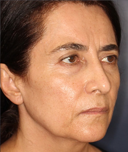 Face & Neck Lift Before & After Image