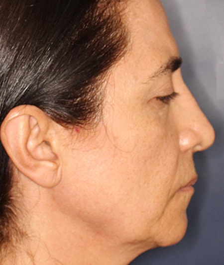 Face & Neck Lift Before & After Image