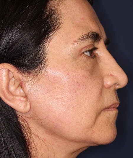 Face & Neck Lift Before & After Image