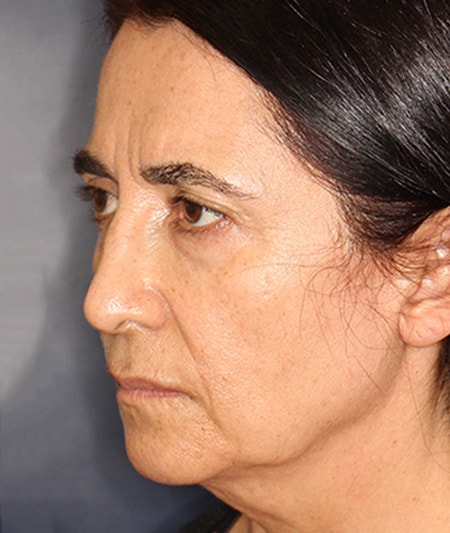 Face & Neck Lift Before & After Image