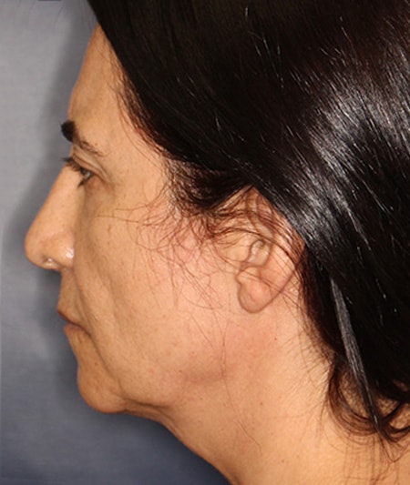 Face & Neck Lift Before & After Image