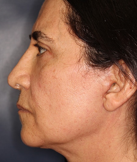 Face & Neck Lift Before & After Image