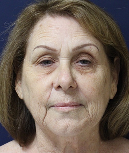 Face & Neck Lift Before & After Image