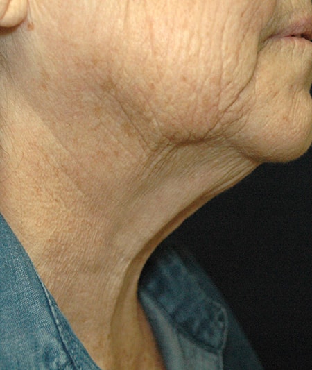 Face & Neck Lift Before & After Image