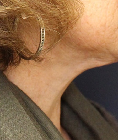 Face & Neck Lift Before & After Image