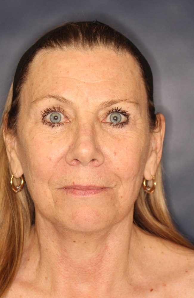 Face & Neck Lift Before & After Image