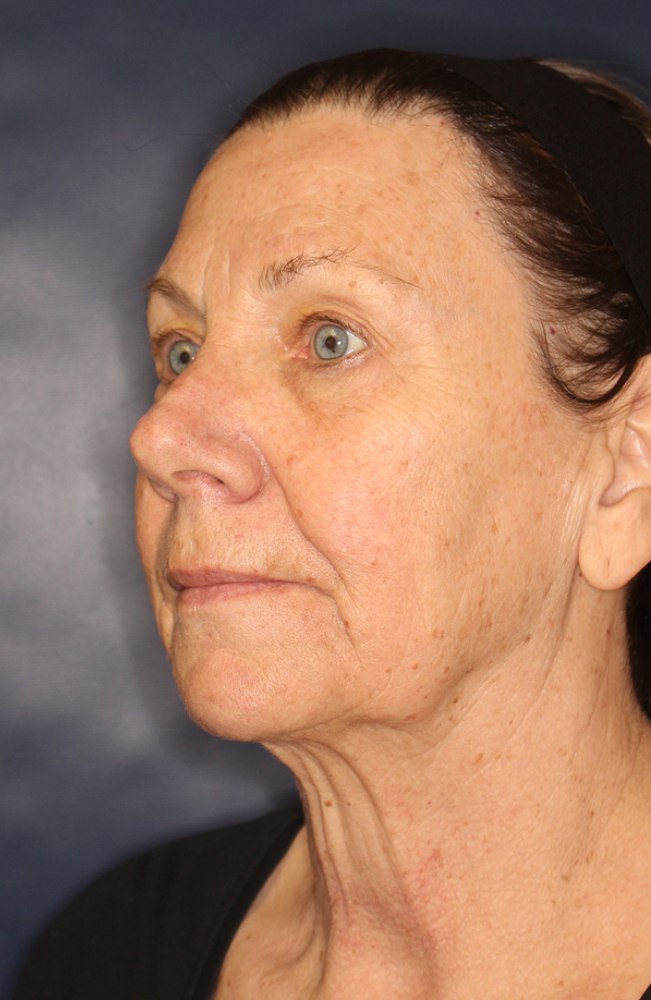 Face & Neck Lift Before & After Image