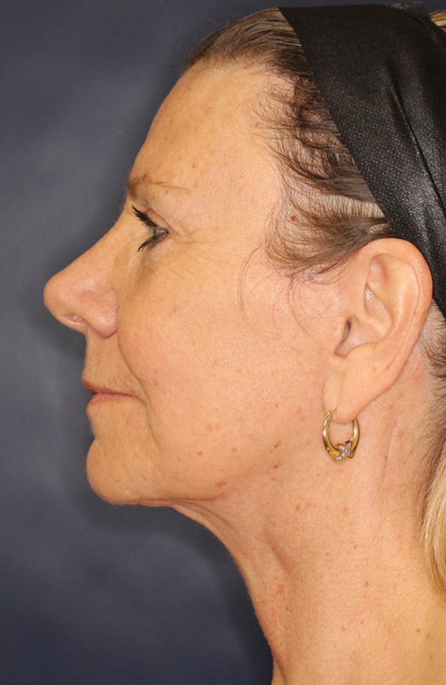 Face & Neck Lift Before & After Image