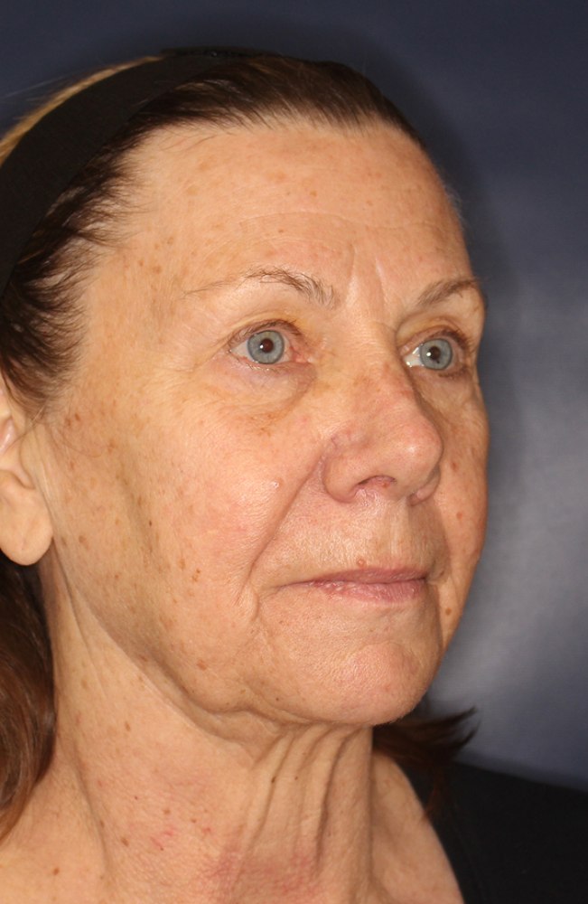 Face & Neck Lift Before & After Image