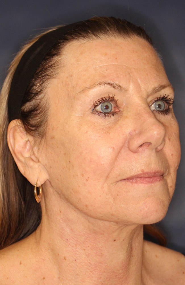 Face & Neck Lift Before & After Image