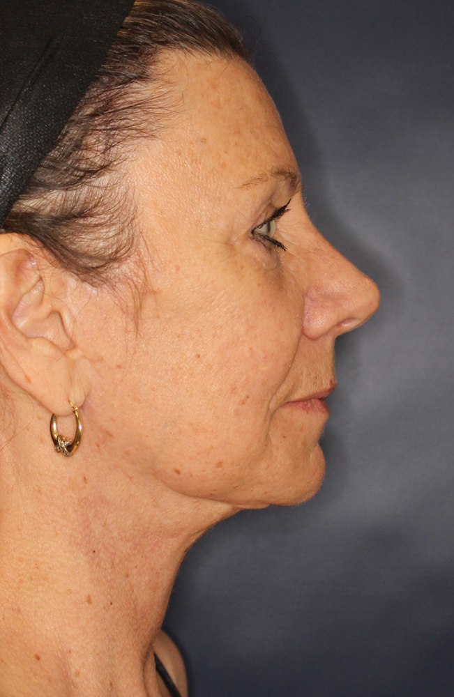 Face & Neck Lift Before & After Image
