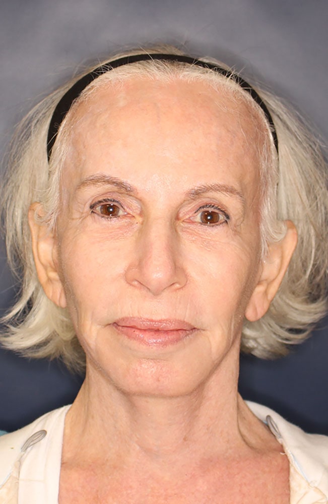 Face & Neck Lift Before & After Image