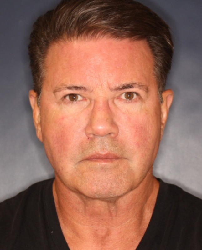Face & Neck Lift Before & After Image