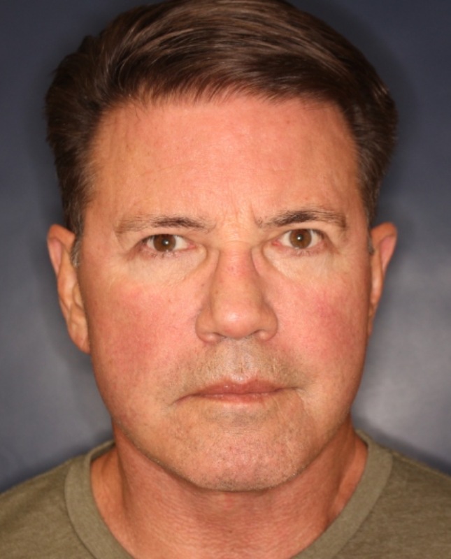 Face & Neck Lift Before & After Image