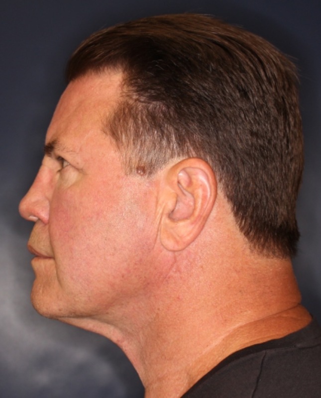 Face & Neck Lift Before & After Image