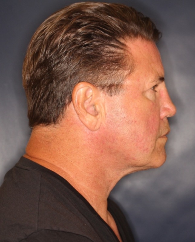Face & Neck Lift Before & After Image
