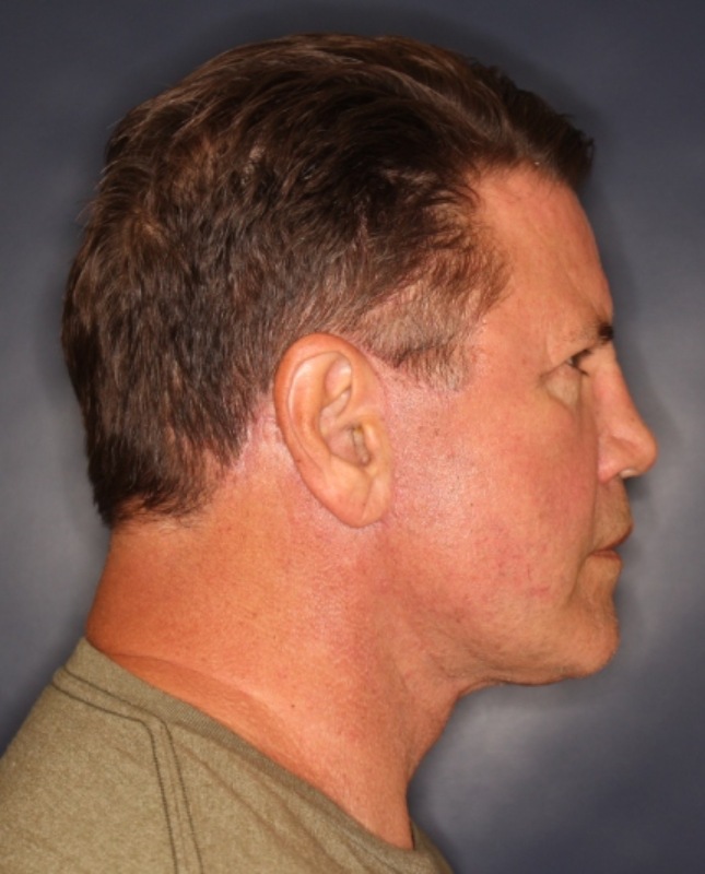 Face & Neck Lift Before & After Image