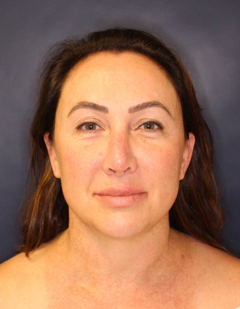 Face & Neck Lift Before & After Image