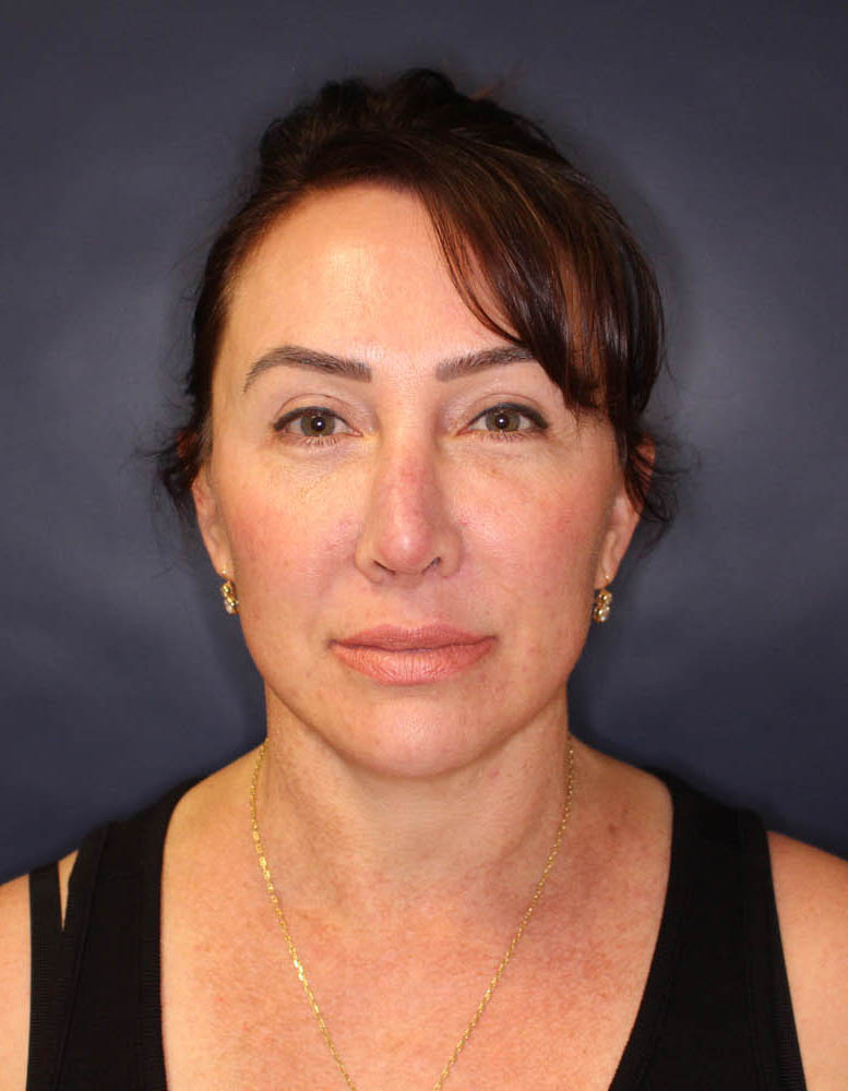 Face & Neck Lift Before & After Image