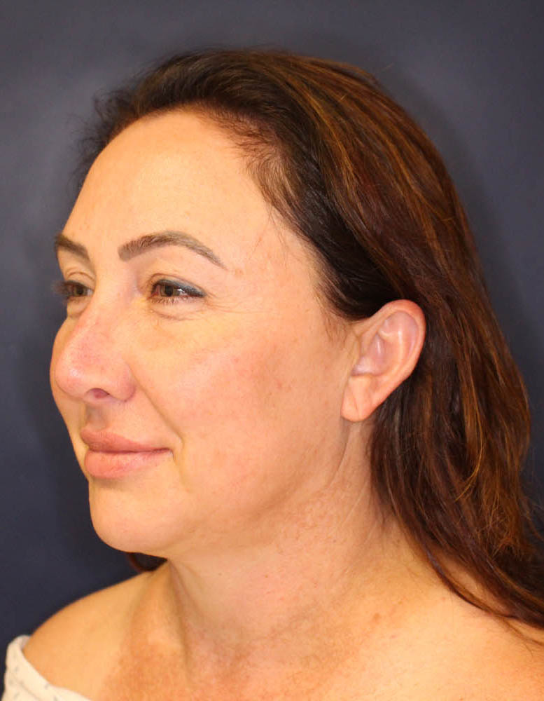 Face & Neck Lift Before & After Image