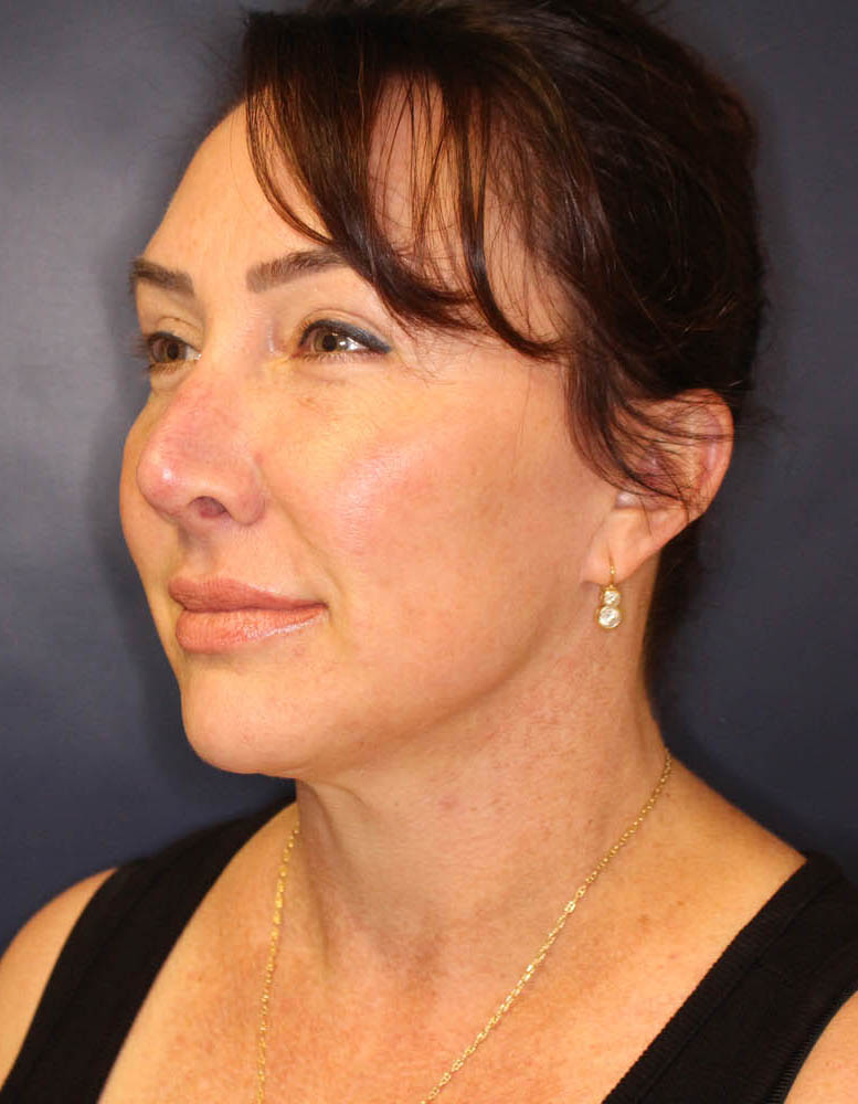 Face & Neck Lift Before & After Image