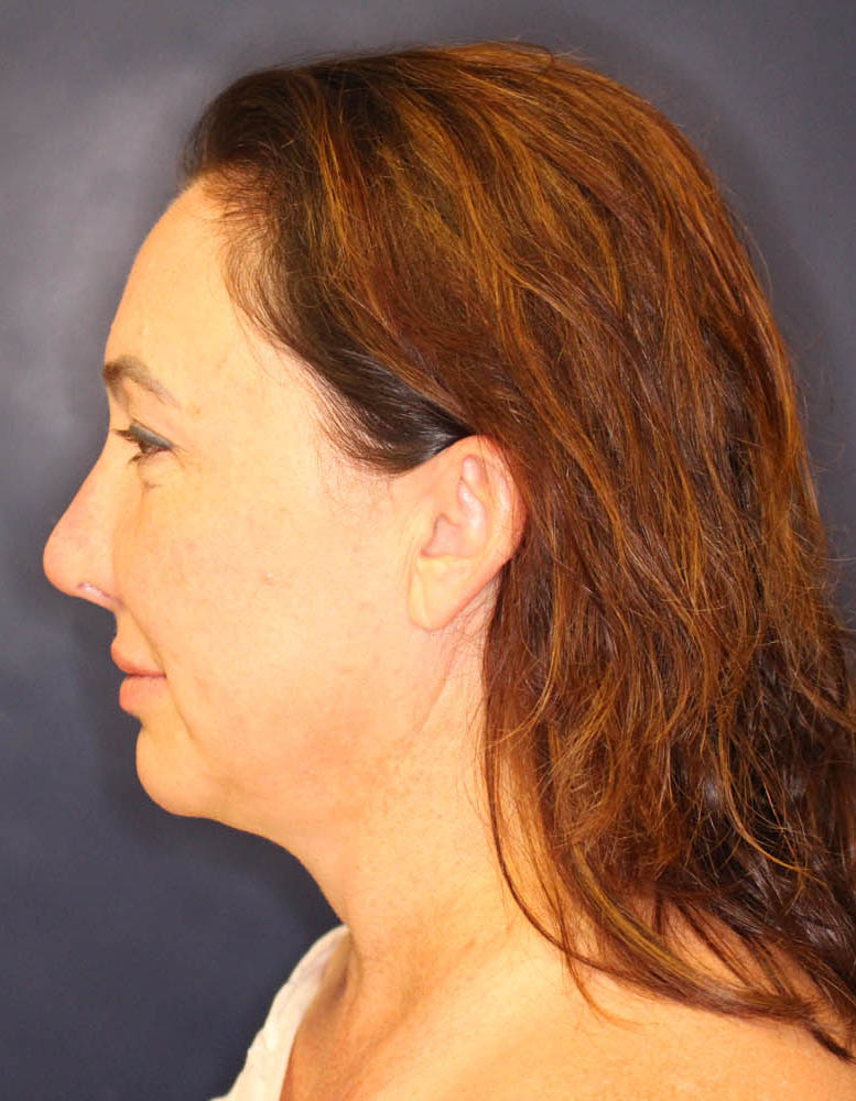 Face & Neck Lift Before & After Image