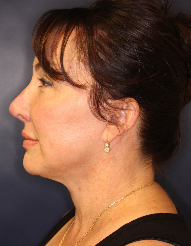 Face & Neck Lift Before & After Image