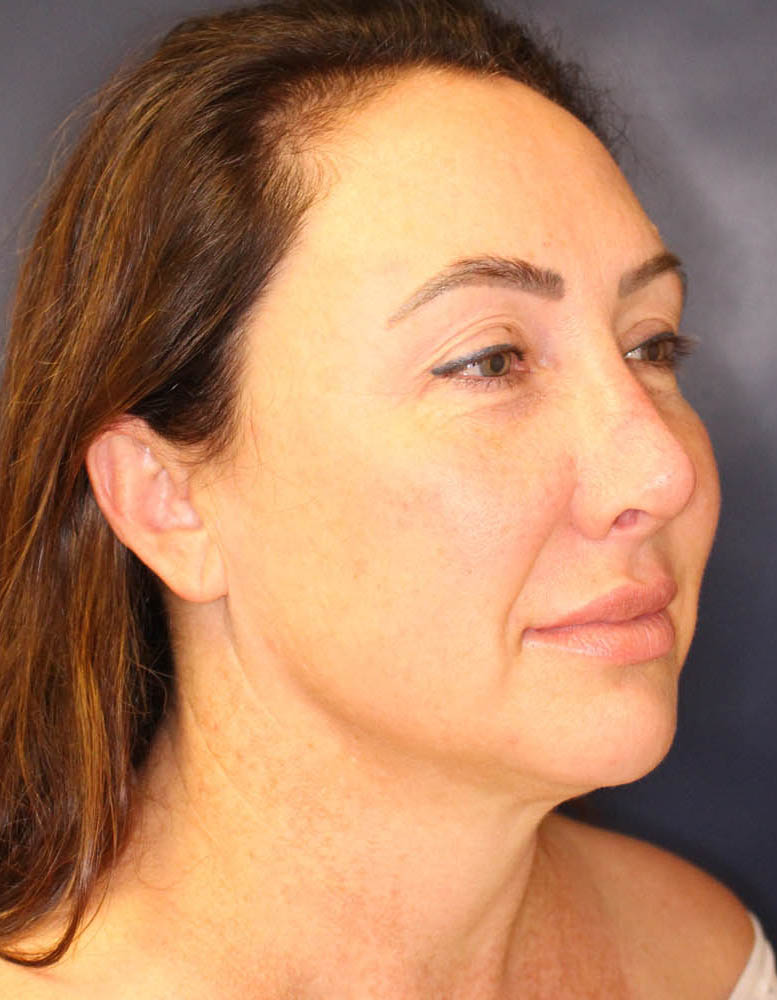 Face & Neck Lift Before & After Image
