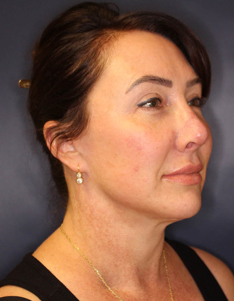Face & Neck Lift Before & After Image